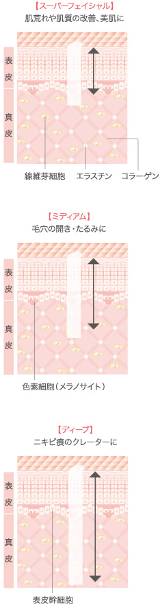 スーパーフェイシャル、ミディアム、ディープ
