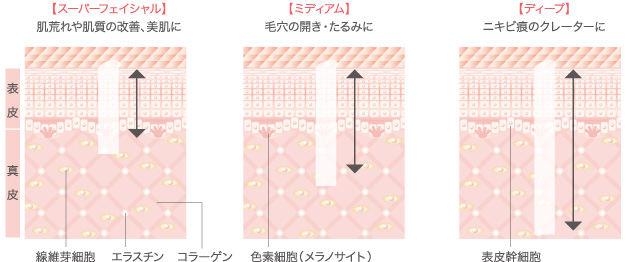 スーパーフェイシャル、ミディアム、ディープ